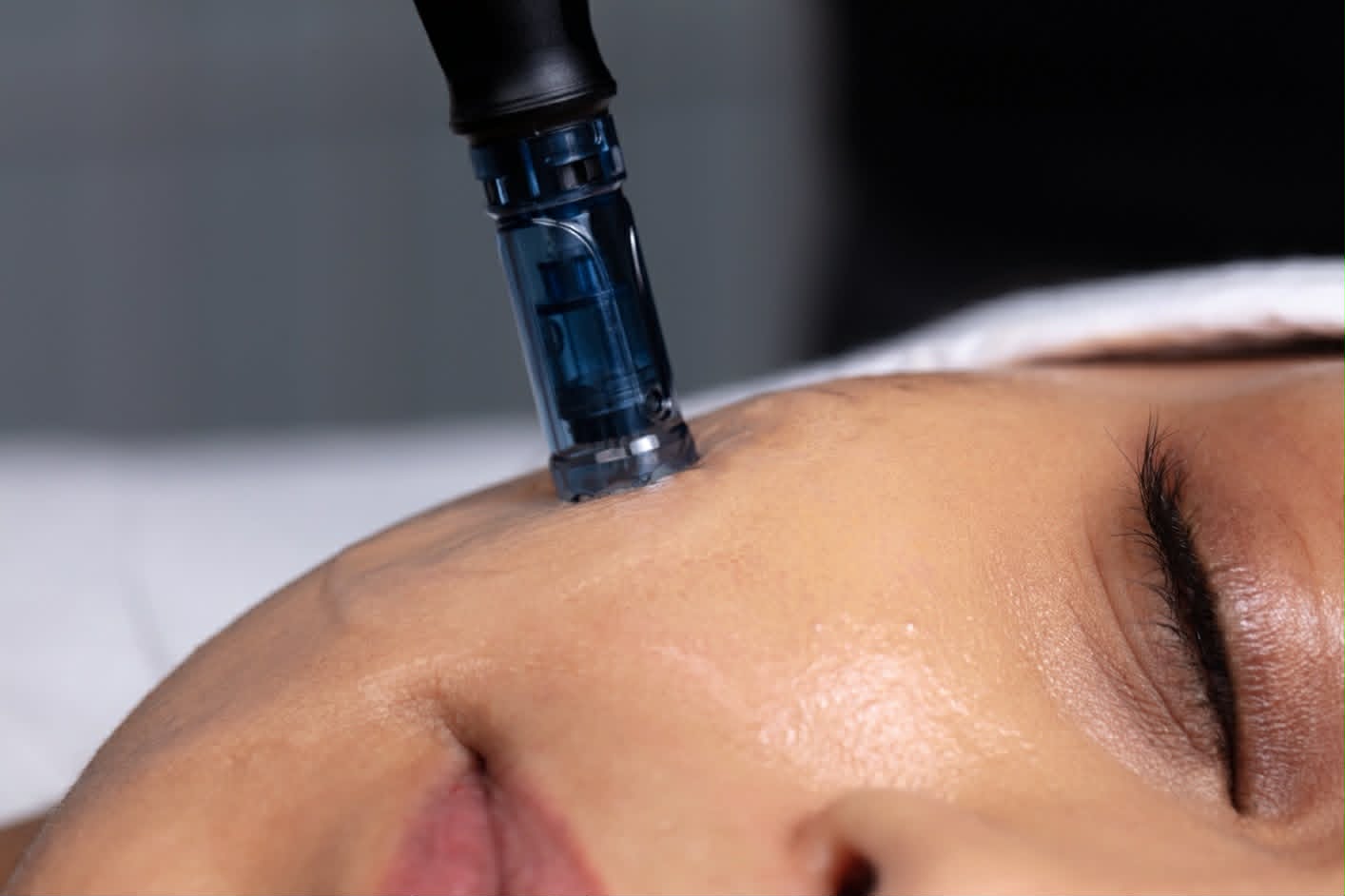 Microneedling advanced skin treatment